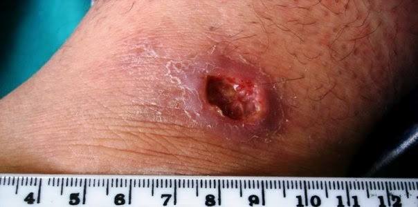 SAMAN� ALERTA POR APARICI�N DE LA LEISHMANIASIS